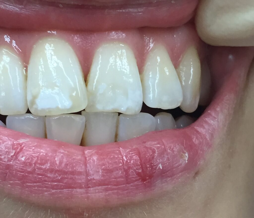 Mund mit Zähnen mit weißen Flecken auf dem Schmelz