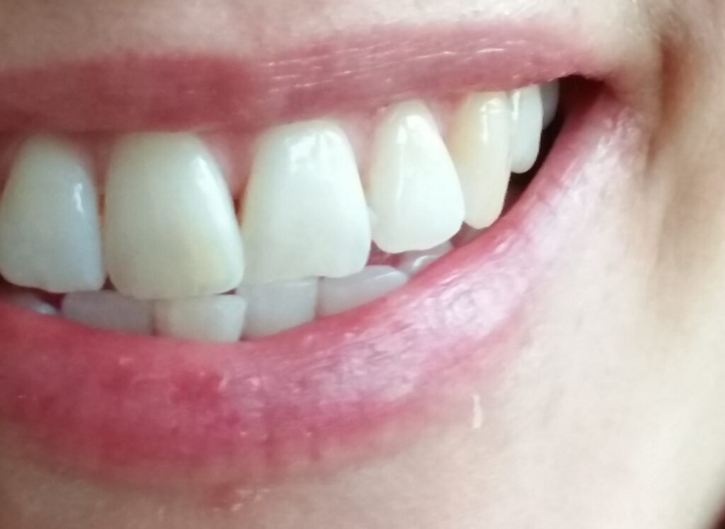 Mund mit Zähnen ohne weiße flecken